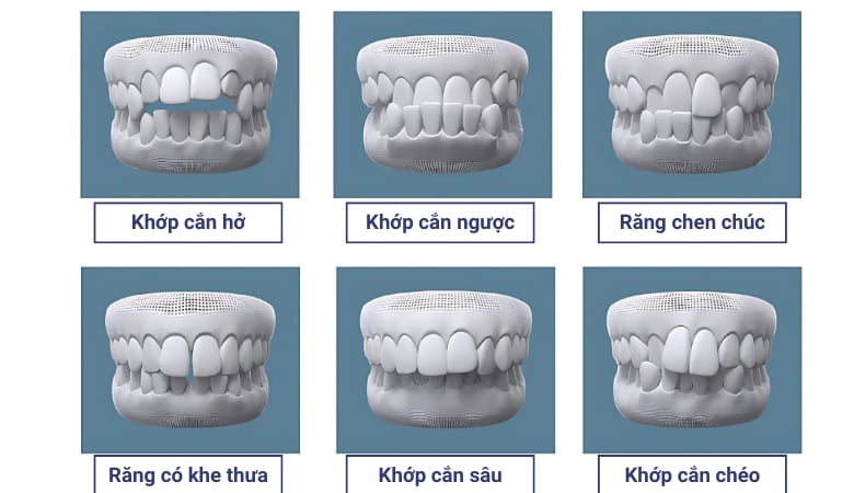 Lưu ý khi niềng răng Invisalign - 3