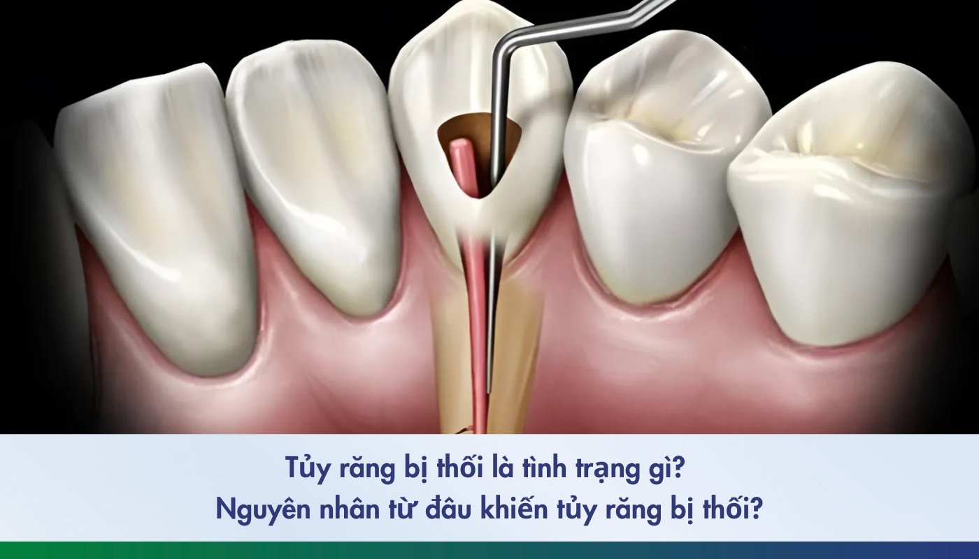 tủy răng bị thối