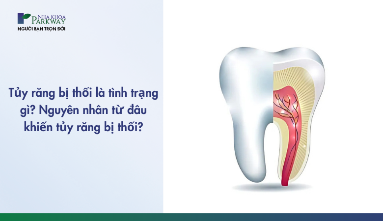 tủy răng bị thối là tình trạng gì?