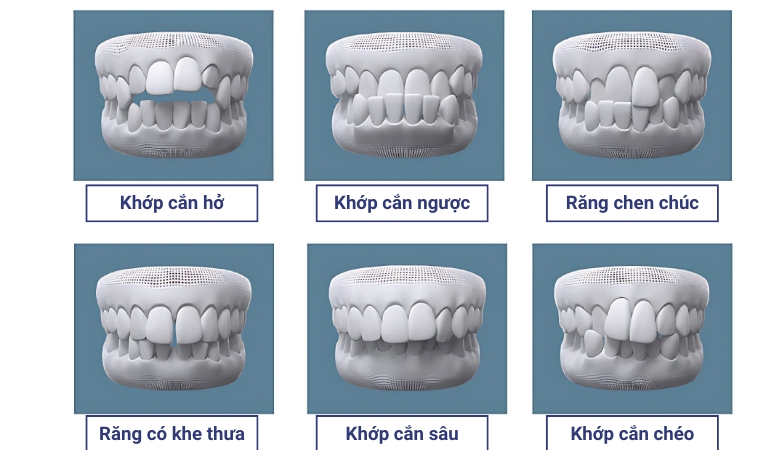 quy trình niềng răng invisalign - 3