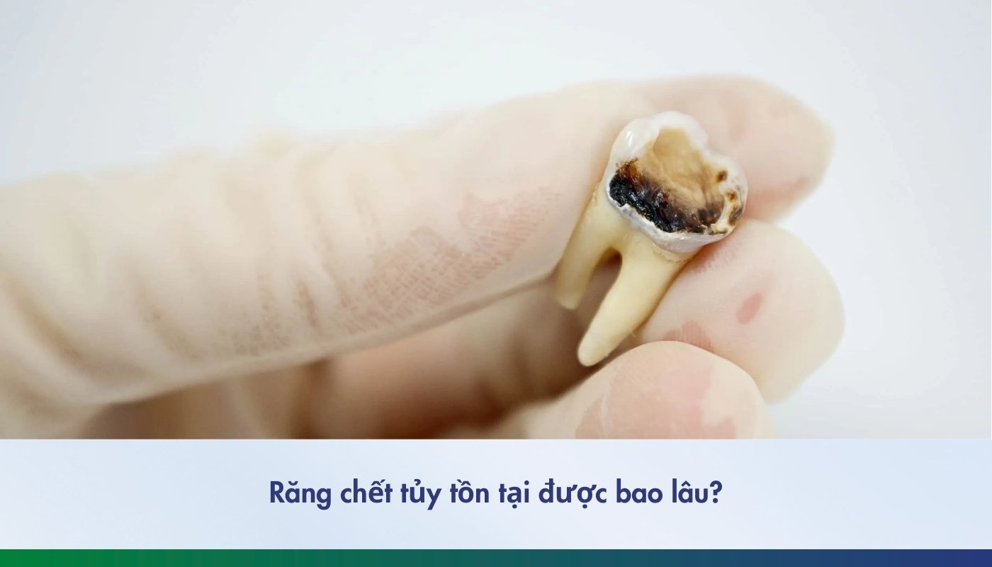 Răng chết tủy tồn tại được bao lâu