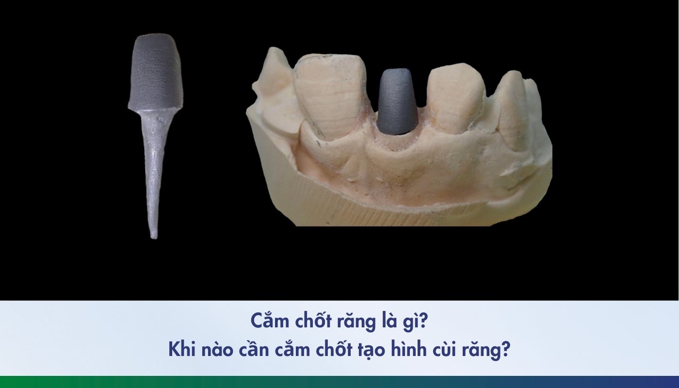 Cắm chốt răng là phương pháp giúp tái tạo cùi răng sau điều trị tủy