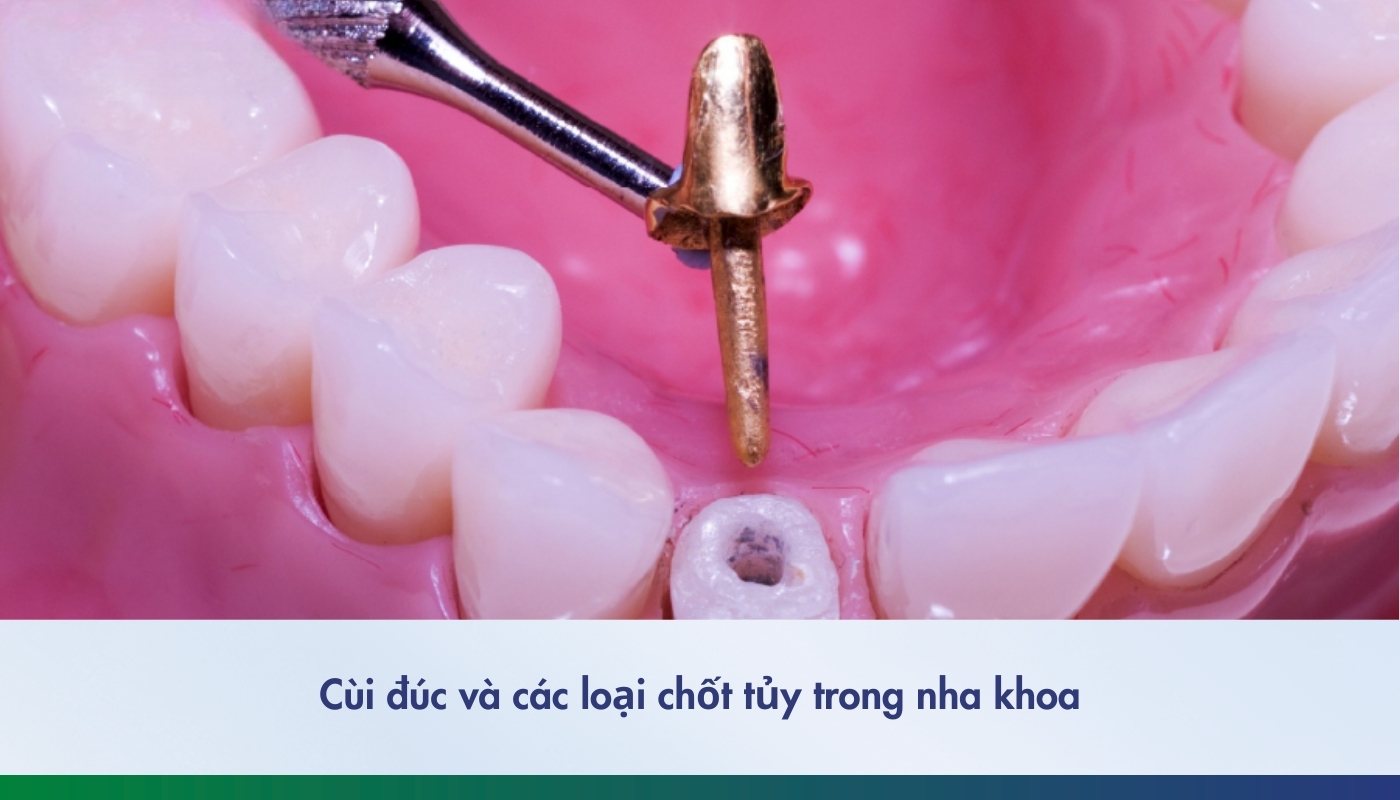 Cùi đúc và các loại chốt tủy phổ biến trong nha khoa