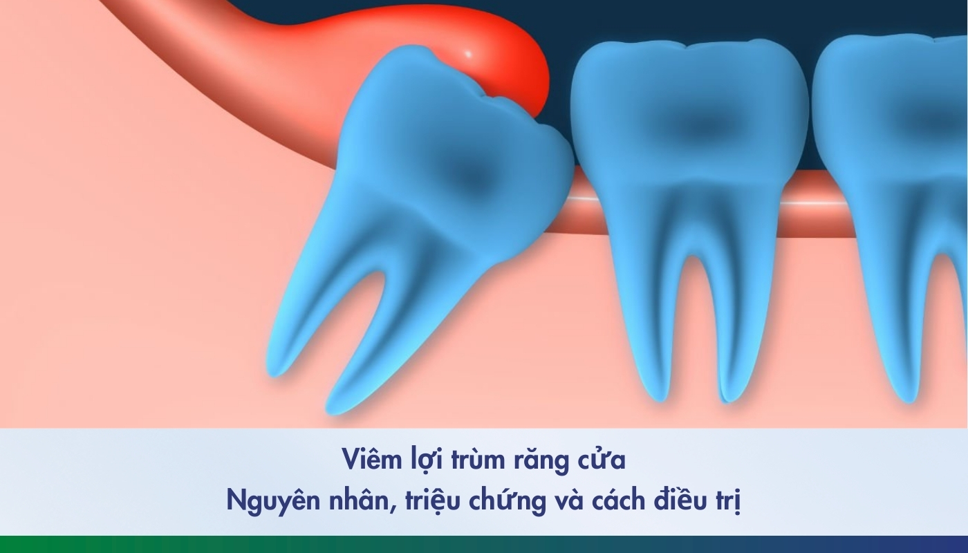 Viêm lợi trùm