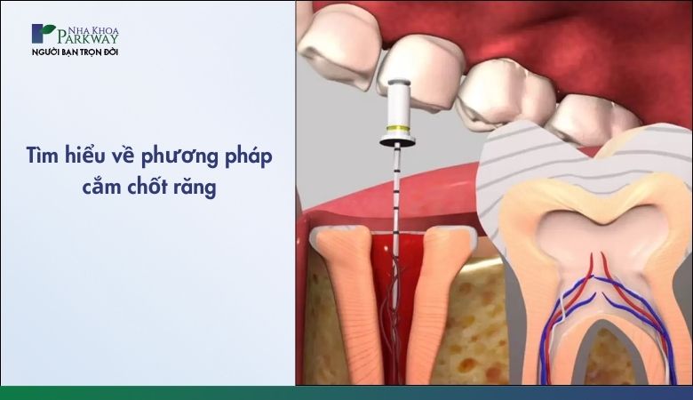 Tìm hiểu về phương pháp cắm chốt răng