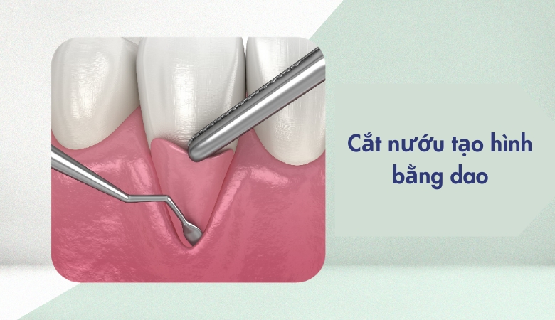 Cắt nướu tạo hình bằng dao