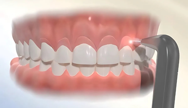 cắt nướu tạo hình bằng laser