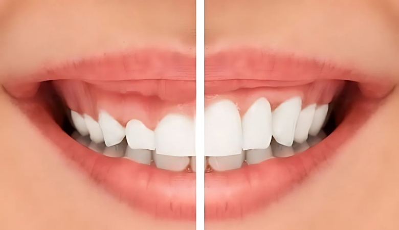 Cắt nướu bị viêm