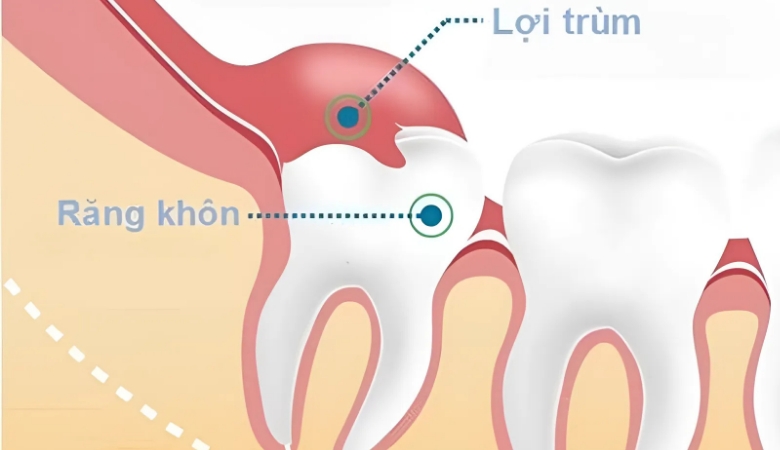 Cắt lợi trùm trên răng khôn