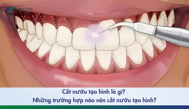 Cắt nướu tạo hình và nhưững phương pháp