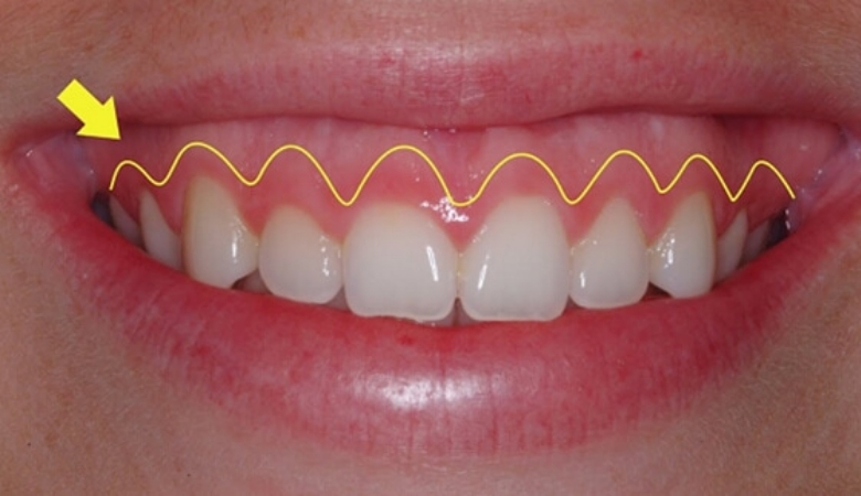 Cắt nướu tạo hình là gì