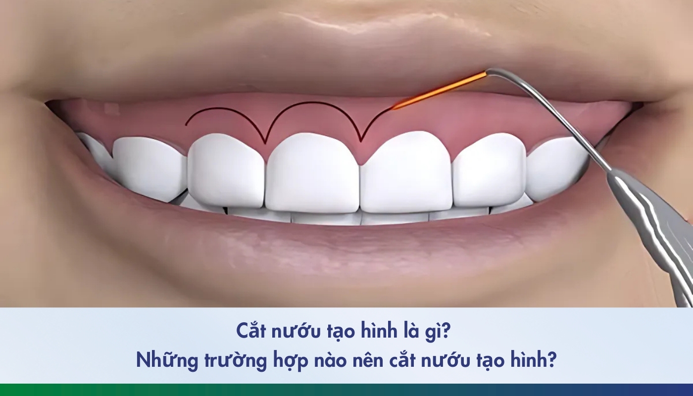 cắt nướu tạo hình là gì và nhữnxg phương pháp
