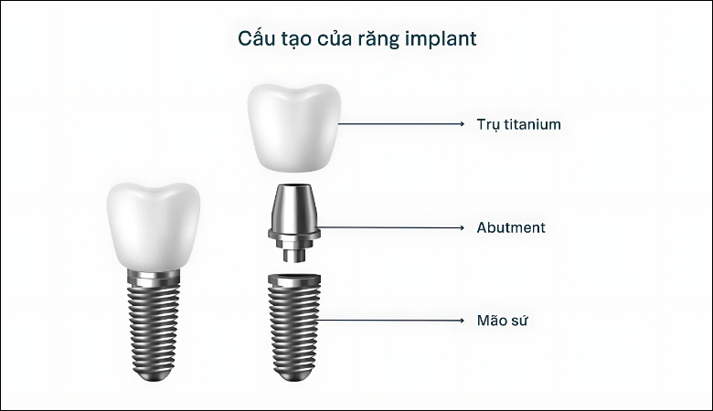 Trồng răng Implant chi phí