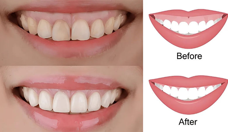 Cắt nướu tạo hình cười hở lợi