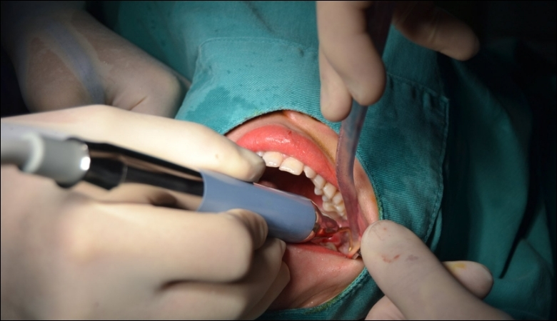 Nhổ răng nhẹ nhàng với công nghệ Piezotome