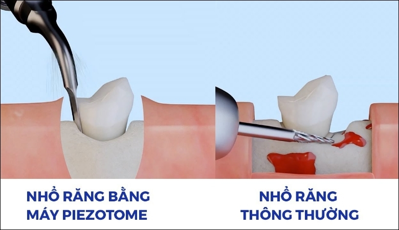 Nhổ răng bằng máy Piezotome có nhiều lợi ích vượt trội so với phương pháp truyền thống