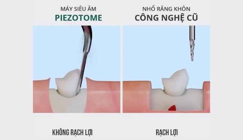 Máy Piezotome thực hiện thao tác cắt chính xác giúp hạn chế các tổn thương mô mềm