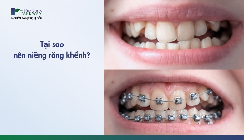 Vì sao nên niềng răng khểnh