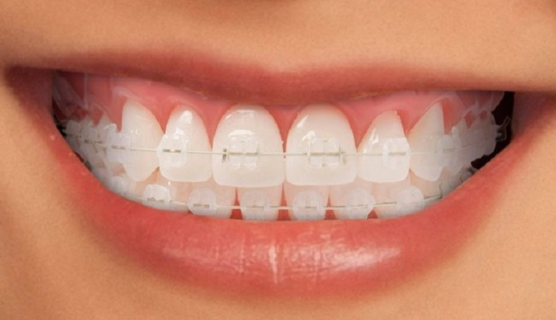 Khắc phục răng khểnh bằng phương pháp niềng mắc cài sứ