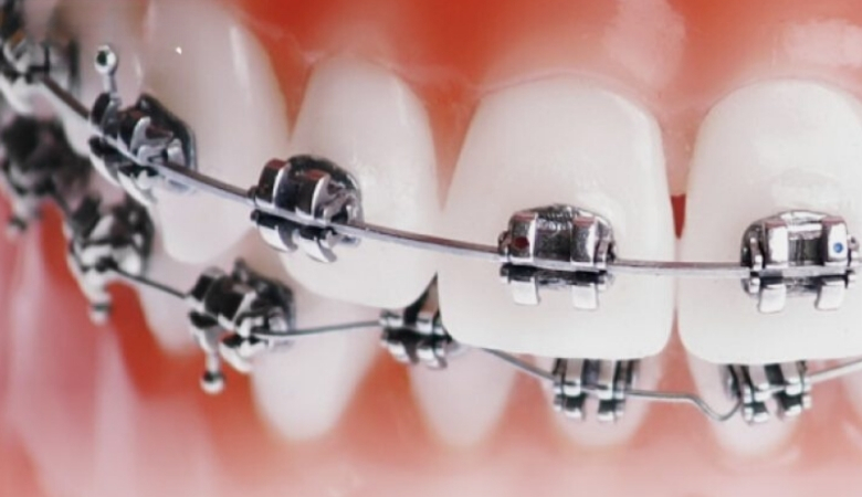 Niềng răng mắc cài tự động