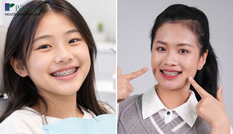 Thời gian niềng răng hiệu quả của trẻ em và người lớn