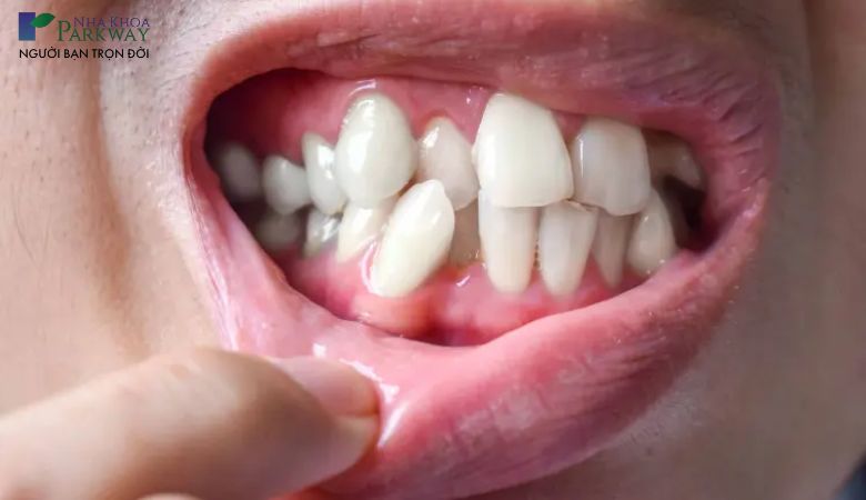 Tình trạng răng sẽ ảnh hưởng đến thời gian niềng 