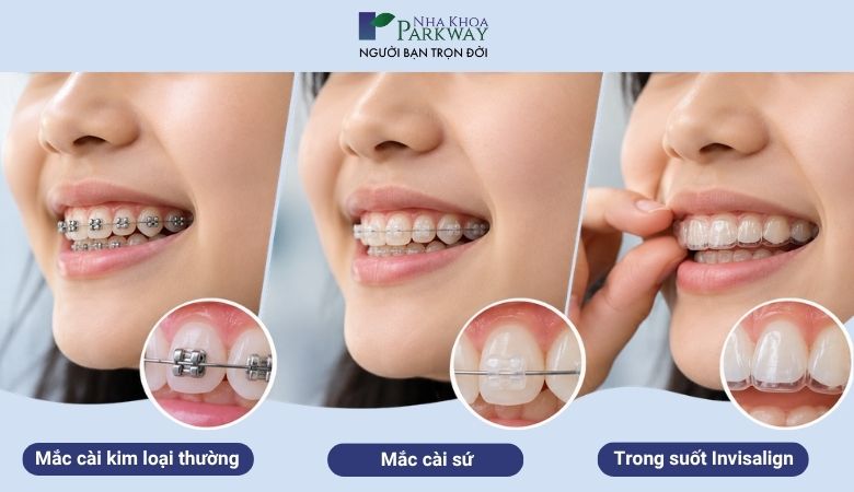 Mỗi phương pháp niềng răng sẽ có thời gian tối ưu khác nhau