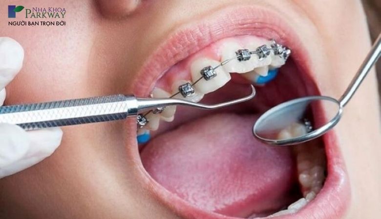 Sau khi niềng từ 1 đến 3 tháng răng sẽ bắt đầu dịch chuyển