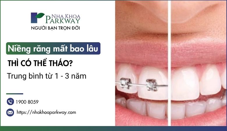 Niềng răng mất bao lâu thì tháo? Trung bình từ 1-3 năm