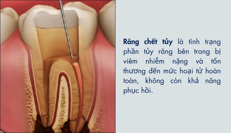 Răng chết tủy là những răng mà buồng tủy đã bị hoại tử hoàn toàn