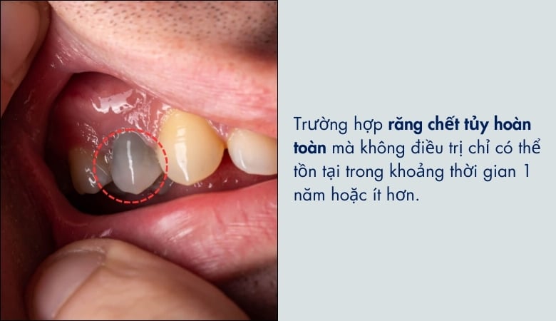 Răng chết tủy có thể tồn tại được 1 năm hoặc ít hơn