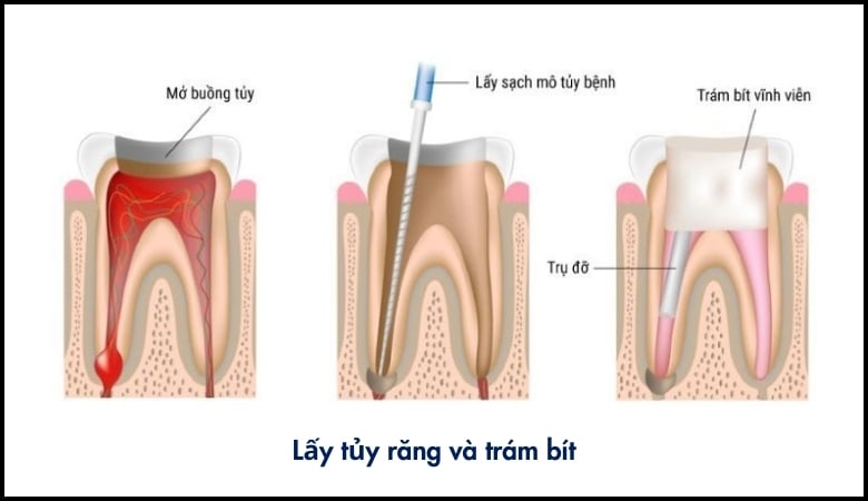 Lấy tủy răng và trám bít để ngăn ngừa vi khuẩn lan rộng