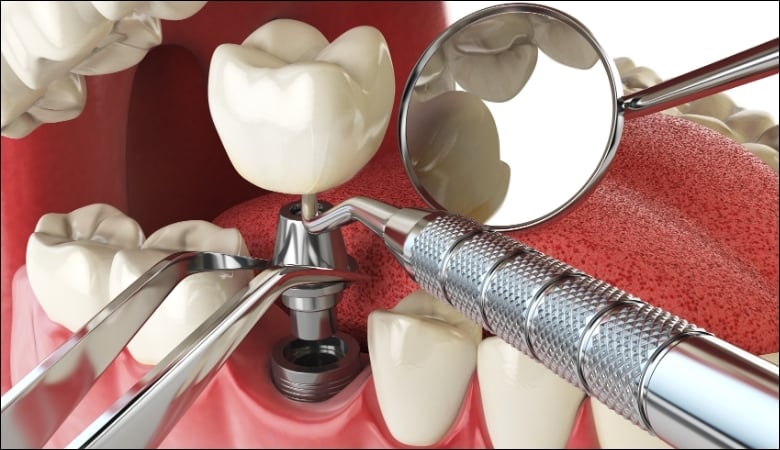 Cấy ghép Implant trong trường hợp phải nhổ răng chết tủy