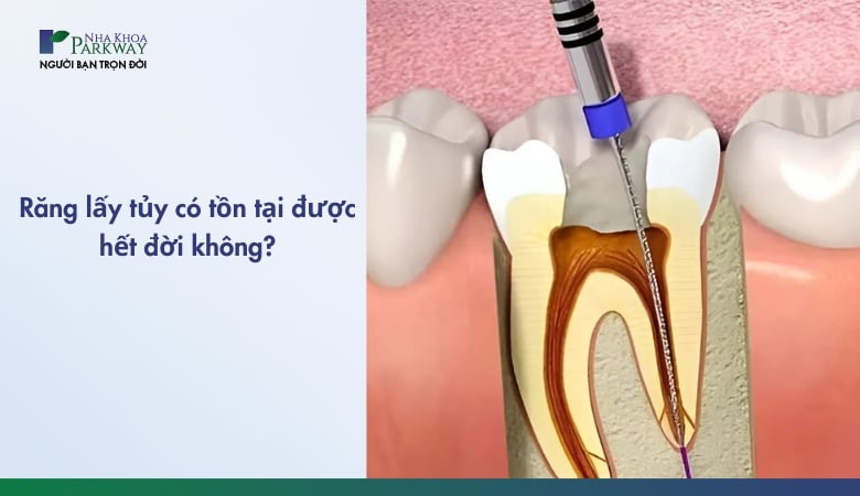 Răng lấy tủy có tồn tại được hết đời không - 2