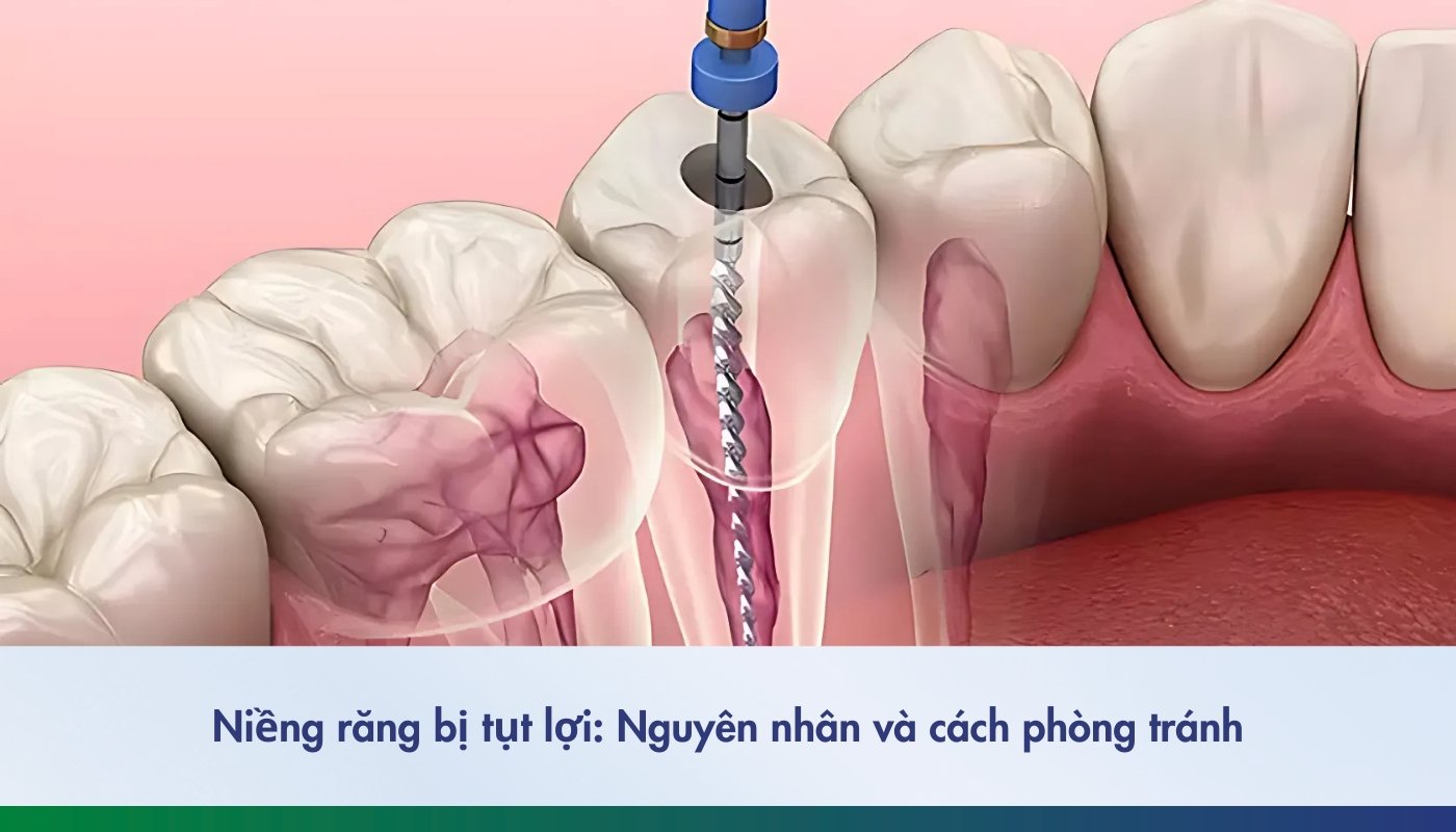 Răng lấy tủy có tồn tại được hết đời không - 1