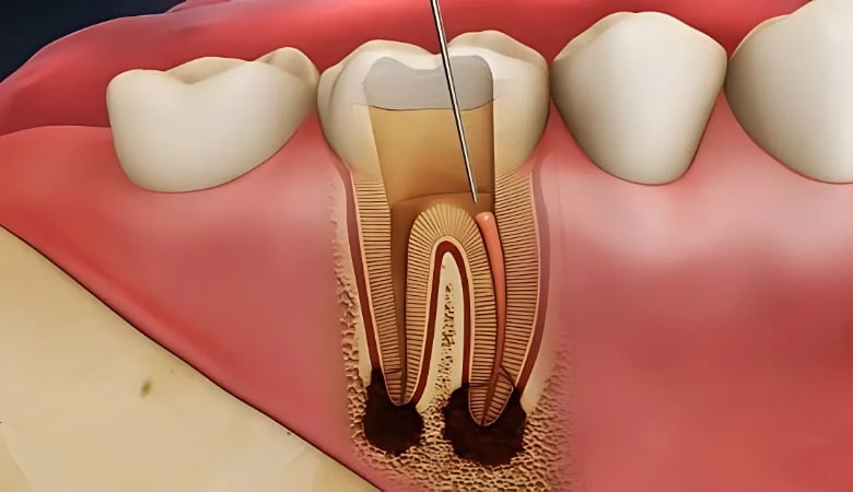 Răng lấy tủy có tồn tại được hết đời không - 7