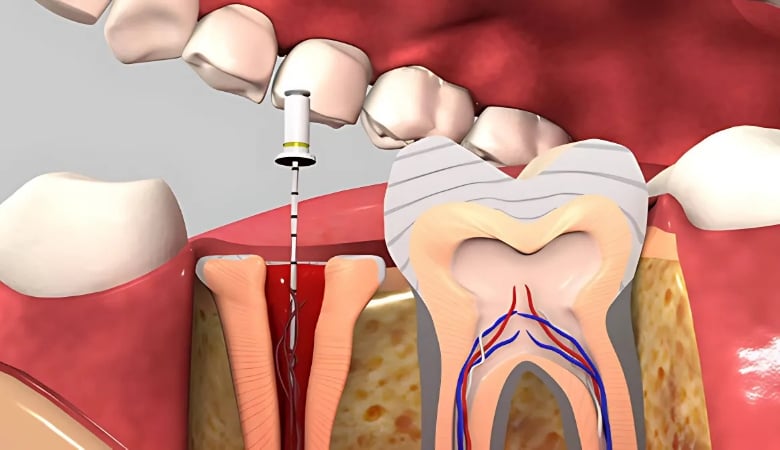 Răng lấy tủy có tồn tại được hết đời không - 8