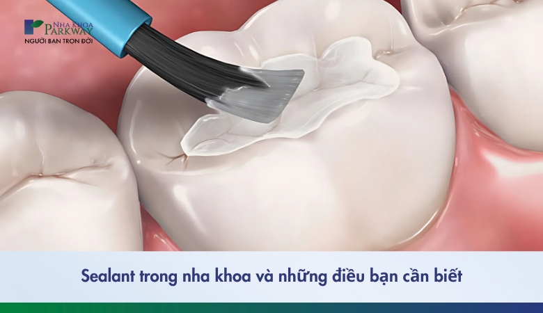 Sealant trong nha khoa va những điều cần biết