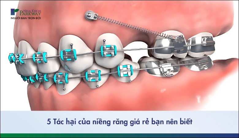 tác hại của niềng răng bạn nên biết - 2