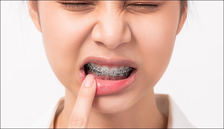 Tác hại của niềng răng - 3