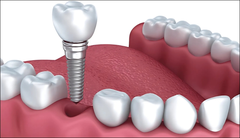 Trồng răng implant vĩnh viễn phục hồi răng mất