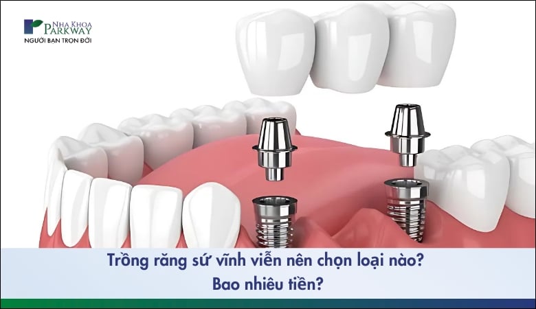 Trồng răng sứ vĩnh viễn trên Implant