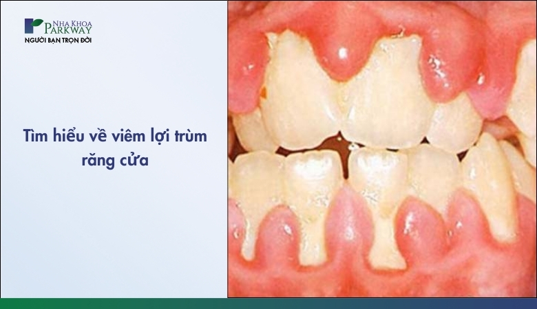 Viêm lợi trùm răng cửa và những dấu hiệu nhận biết