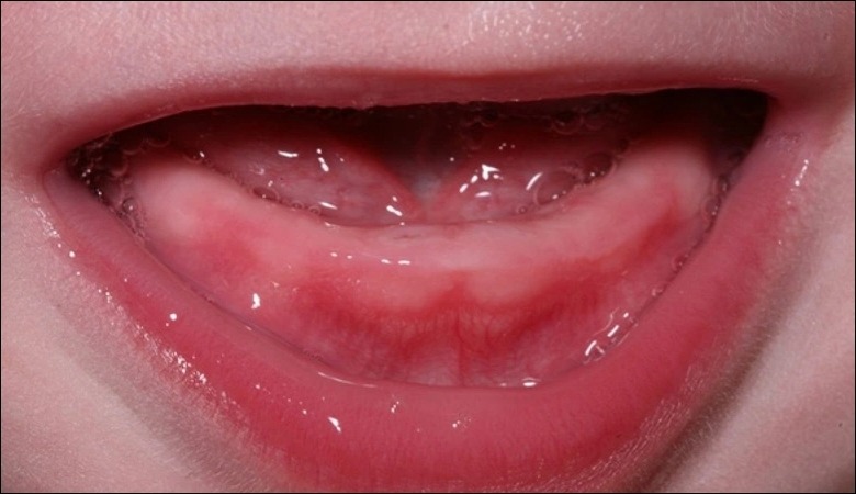 Sưng viêm vùng nướu là nguyên nhân khiến bé sốt khi mọc răng