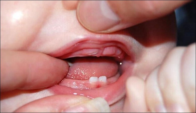 Nướu răng sưng đỏ hoặc bị viêm khi bé mọc răng