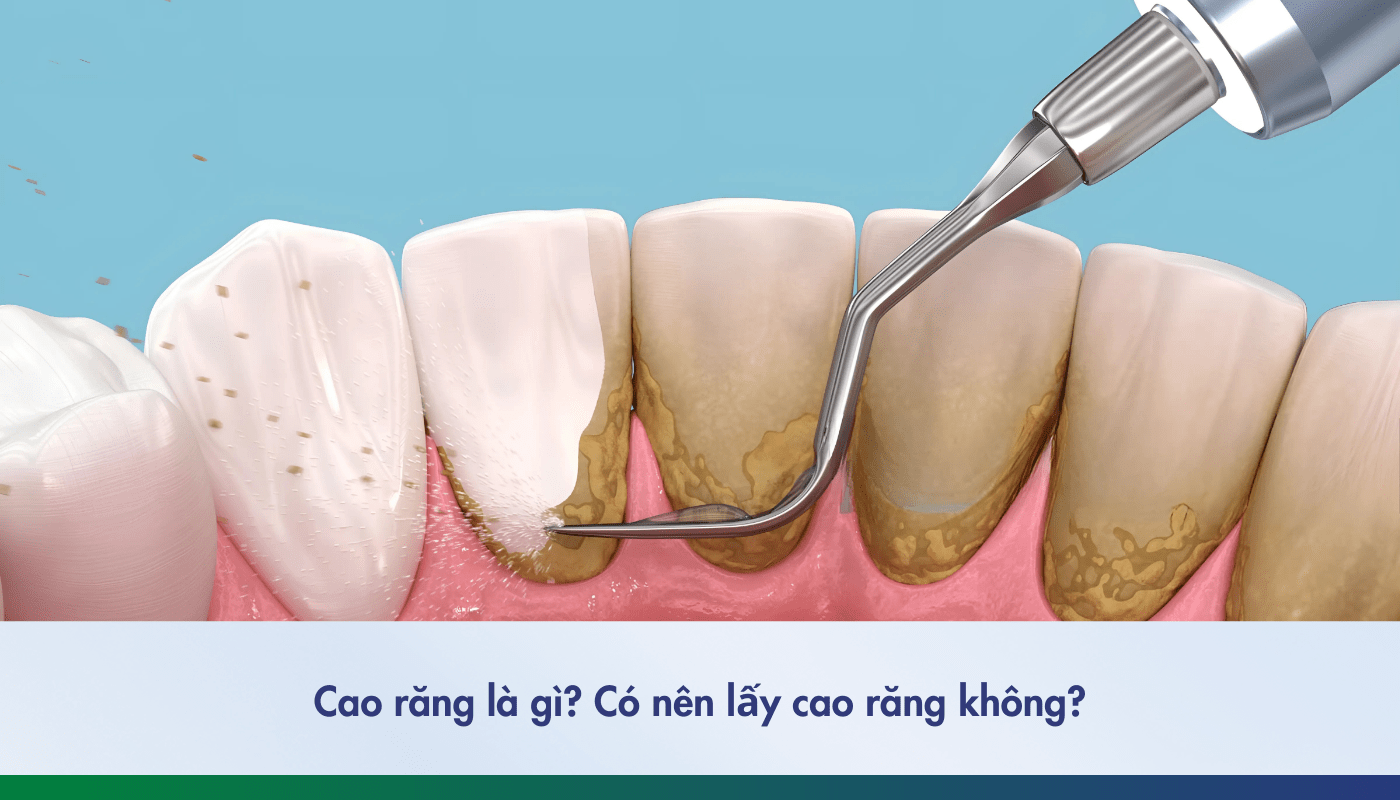 Cao răng là gì và có nên lấy không