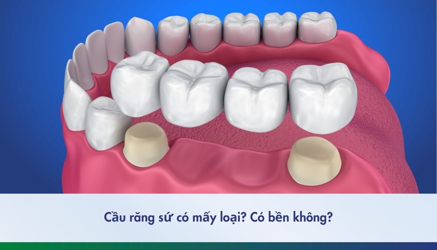 Các loại cầu răng sứ phổ biến