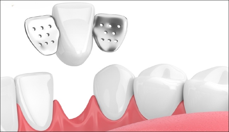 Cầu răng sứ có cánh dán