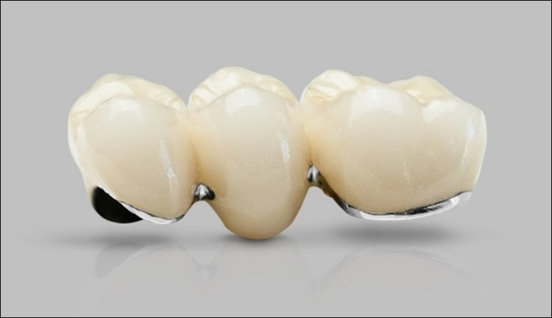 Chất liệu mão sứ quyết định độ bền của cầu răng