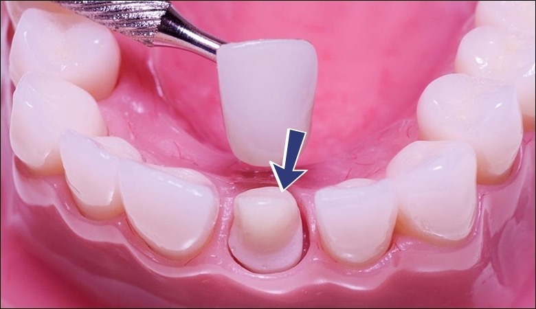 Chất lượng cùi răng tốt giúp tăng độ bền của cầu răng sứ